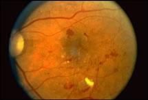 Diabetic Retinopathy