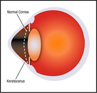 Keratocounus