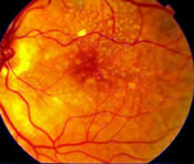 Macular Degeneration